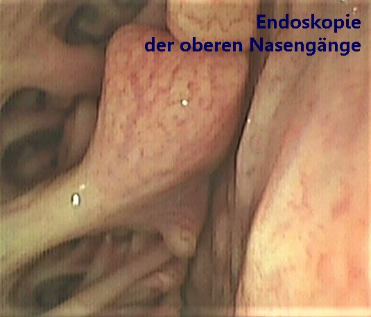 a-obere Nasengänge