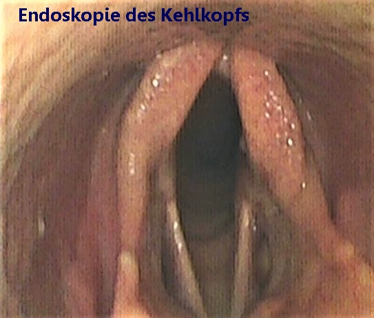 d-Kehlkof